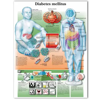 WANGART Anatomijos Plakatas, cukrinio Diabeto Diagramos Drobė Spausdinti Sienos Nuotrauka už Medicinos Mokslo